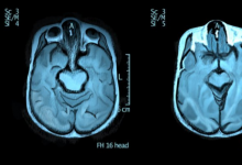 研究人員發(fā)現(xiàn)自閉癥患者的大腦更加對稱