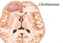 深信服網(wǎng)絡通過MRI掃描檢測膠質(zhì)母細胞瘤腫瘤