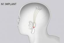 ElonMusk的Neuralink將在大腦中放入細線來控制設(shè)備